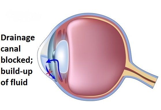 Glaucoma-Eye12-1440w
